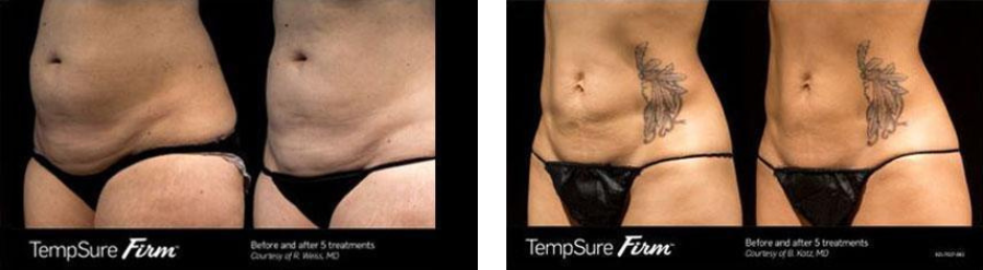 A before and after picture of the same woman 's stomach.